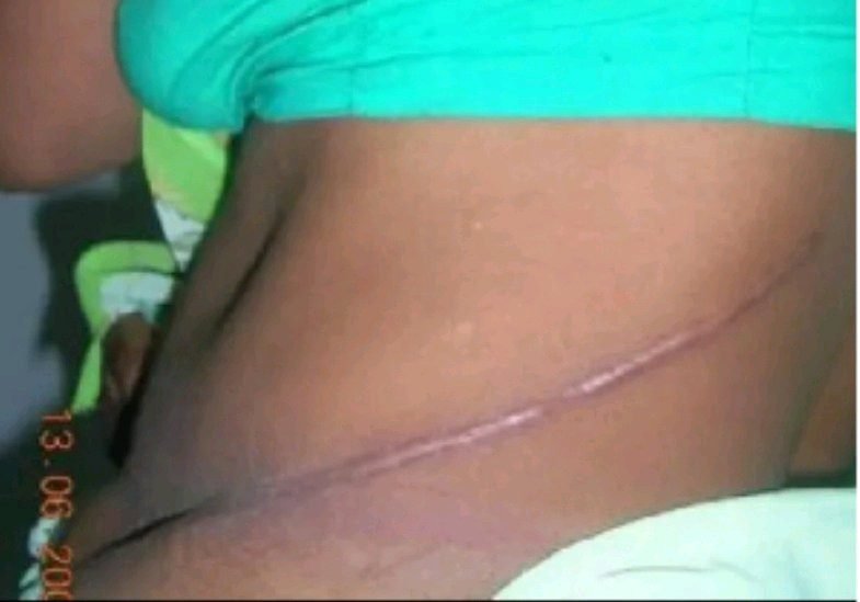 Shocking: Ghanaian Woman Returns from Singapore Vacation with 1 Missing Kidney 1 Ghanaian