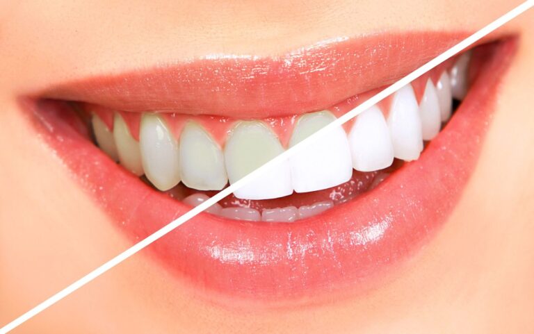 What is the natural color of a healthy tooth? Clearing The Myths Behind Teeth Whitening.