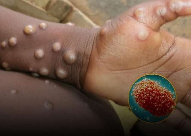 mpox