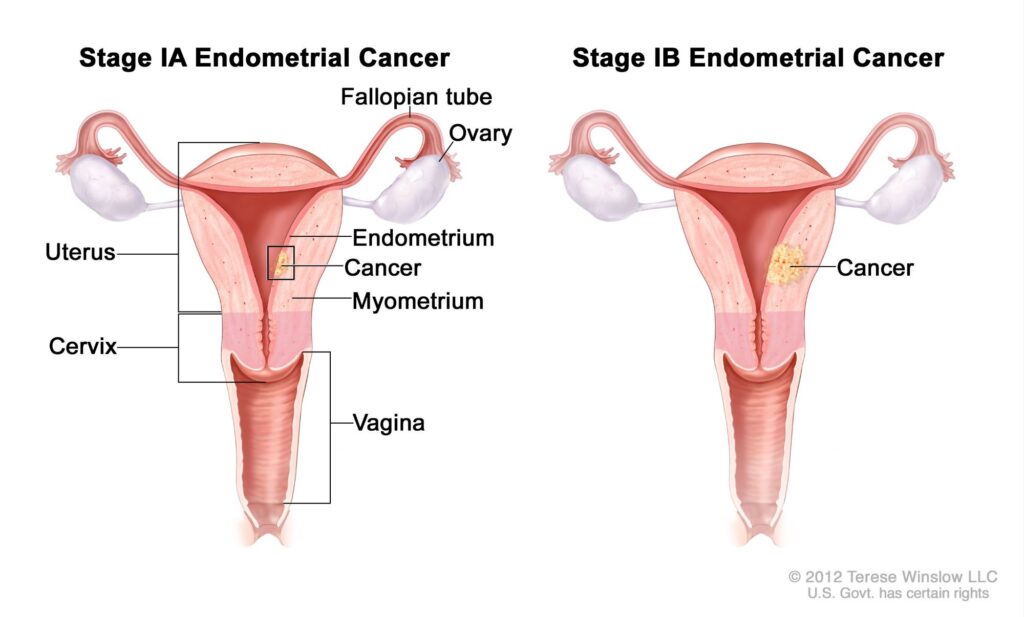 Endometrial Cancer: 7 Essential Insights You Should Know<br> 2 Endometrial