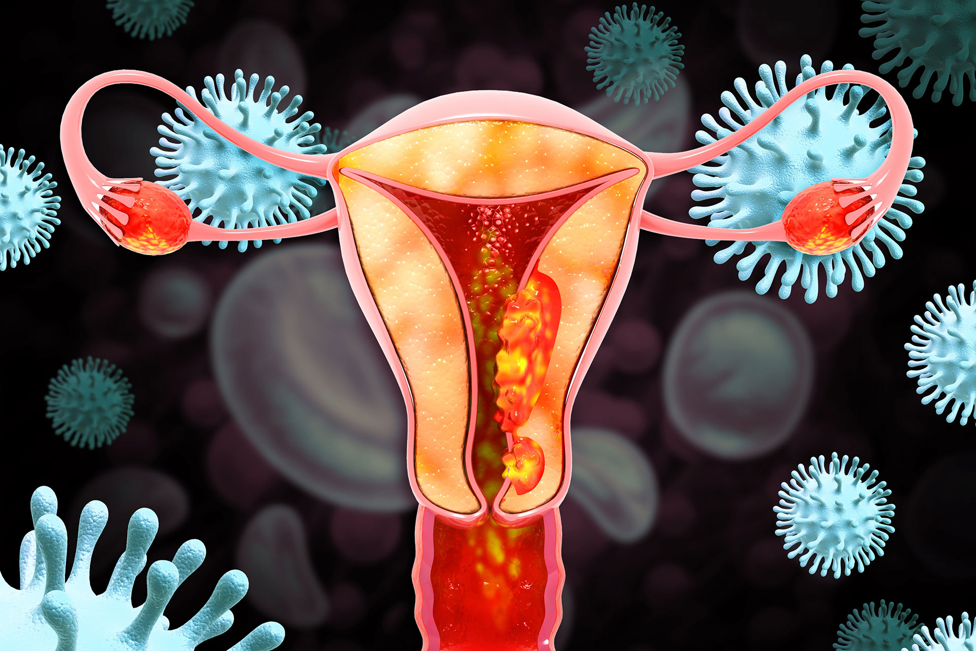 Endometrial Cancer: 7 Essential Insights You Should Know<br> 1 Endometrial