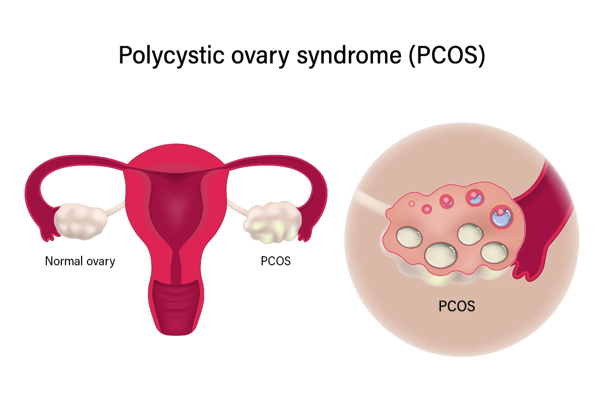 PCOS