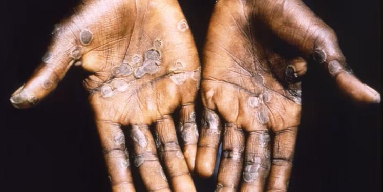 Hopeful News: Nkwanta North District Records and Contains First Mpox Case Successfully 1 Nkwanta