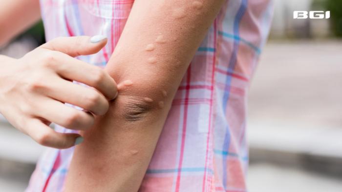 Study warns tropical Chikungunya disease now capable of spreading across most of Europe 4 Chikungunya disease