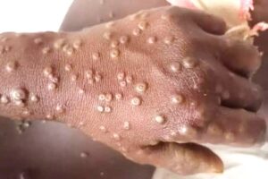 Ghana surpasses 1,000 mpox cases as government intensifies public health response